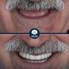 before-after photo all-on-4-dental-implants
