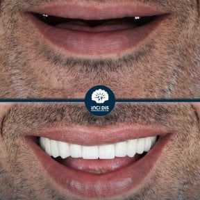 before-after photo all-on-4-dental-implants