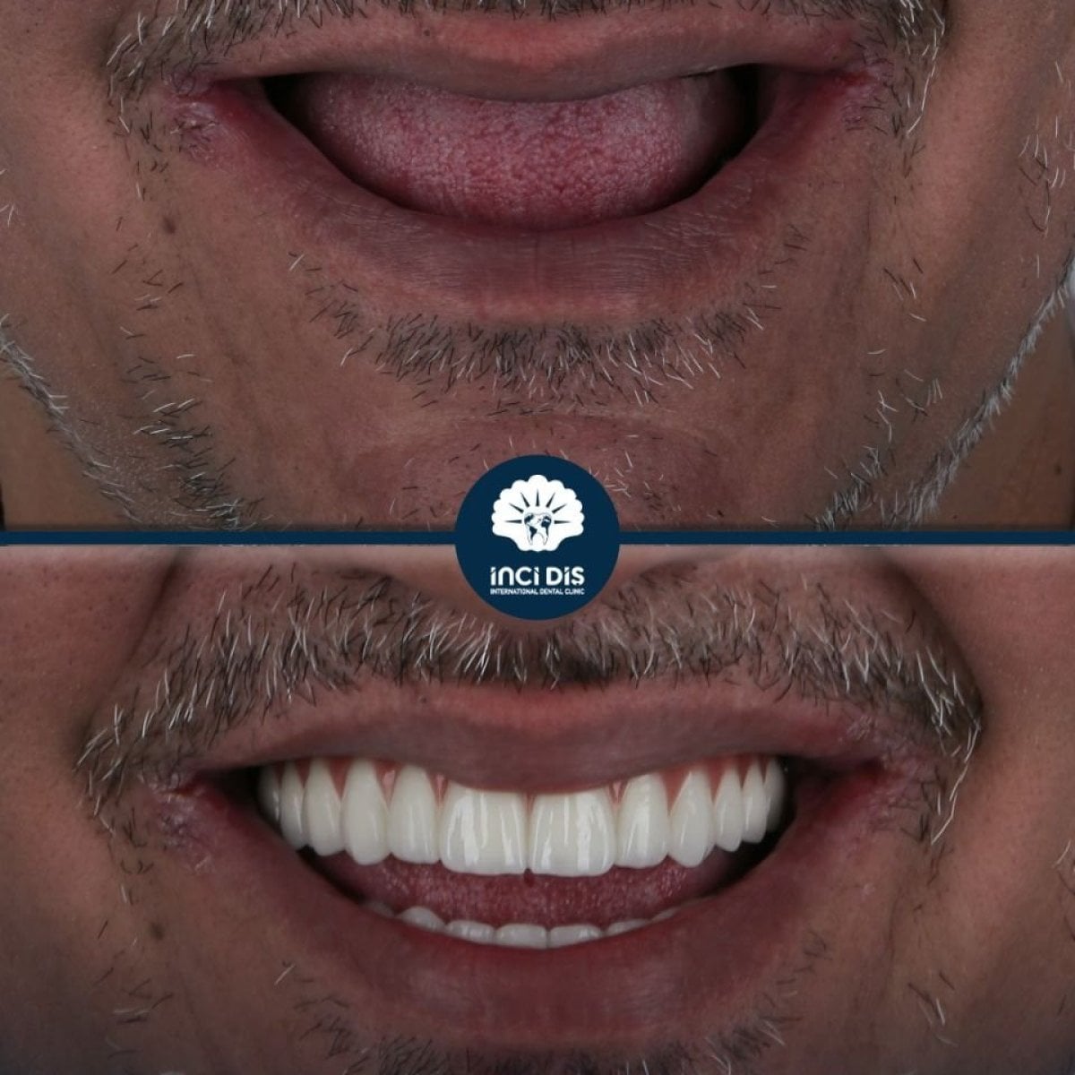 Resultado antes y después de implantes All-on-4 en Inci Dis International, sonrisa restaurada