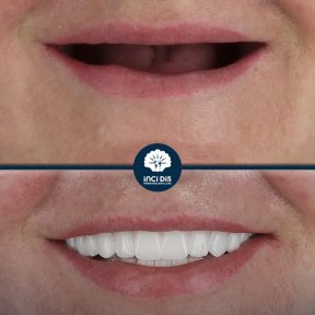 before-after photo all-on-4-dental-implants