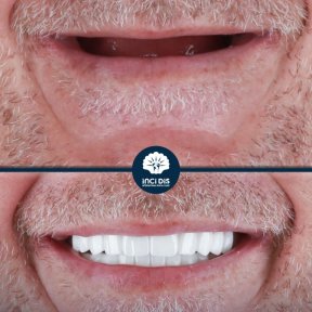 before-after photo all-on-6-dental-implants