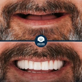 before-after photo all-on-6-dental-implants