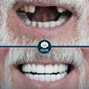 before-after photo all-on-6-dental-implants