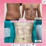 До и после липосакции живота с результатом шести кубиков в Somchai Clinic