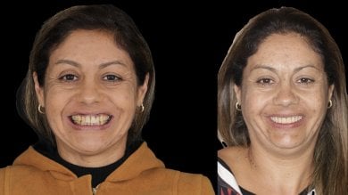 before-after photo all-on-4-dental-implants