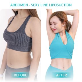 Resultados de liposucción de abdomen antes y después en Wansiri Hospital, cintura más delgada