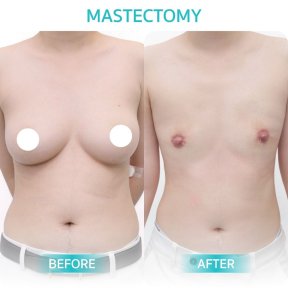 Resultados antes y después de mastectomía en Wansiri Hospital – transformación del tórax