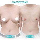 Resultados antes y después de mastectomía en Wansiri Hospital – transformación del tórax
