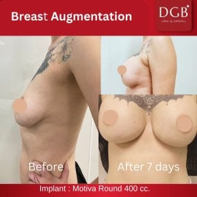Résultats avant et après augmentation mammaire à DGB Clinic, implant Motiva 400cc