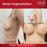 Résultats avant et après augmentation mammaire à DGB Clinic, implant Motiva 400cc