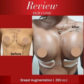 Résultats avant et après augmentation mammaire à la DGB Clinic avec implants 250cc