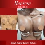 Résultats avant et après augmentation mammaire à la DGB Clinic avec implants 250cc