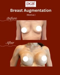 Résultats avant et après augmentation mammaire à la clinique DGB avec implants Motiva