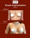 Résultats avant et après augmentation mammaire à la clinique DGB avec implants Motiva