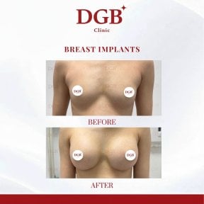 Résultats avant et après implants mammaires à la DGB Clinic, augmentation visible