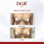 Résultats avant et après implants mammaires à la DGB Clinic, augmentation visible