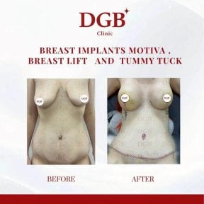 Résultats avant et après implants mammaires, lifting et abdominoplastie à DGB Clinic