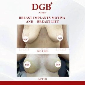 Résultats avant/après retrait d’implants mammaires et lifting à la DGB Clinic, contour amélioré