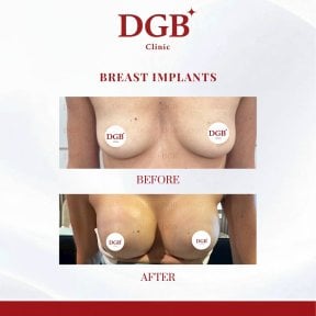 Résultats avant/après implants mammaires à la DGB Clinic, forme et volume améliorés