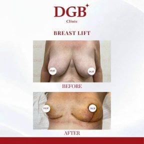 Résultats avant et après lifting mammaire à la DGB Clinic, amélioration du galbe
