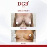 Résultats avant et après lifting mammaire à la DGB Clinic, amélioration du galbe