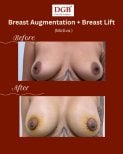 Résultat avant/après augmentation mammaire avec lifting à DGB Clinic, implants Motiva