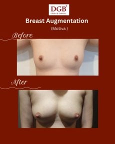 Résultats avant et après augmentation mammaire à la DGB Clinic avec implants Motiva