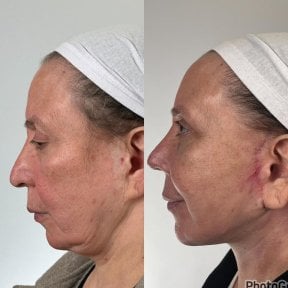 before-after photo tightening-of-facial-skin-facelift
