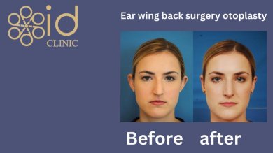 before-after photo rhinoplasty-nose-job