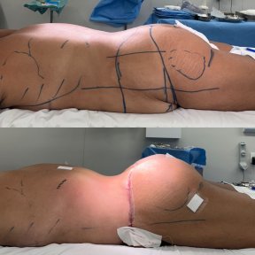 before-after photo post-bariatric-plastic-surgery