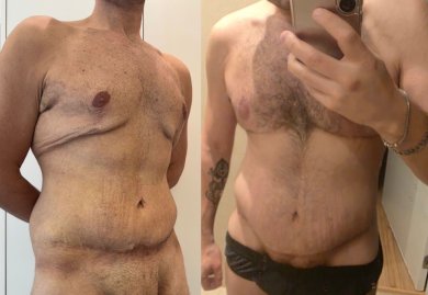 before-after photo post-bariatric-plastic-surgery
