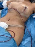 Tummy tuck surgery result at Memorial Göztepe Hospital, abdomen contouring post-operation