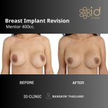 Результаты до и после коррекции грудных имплантов в ID Clinic Bangkok, Mentor 400cc