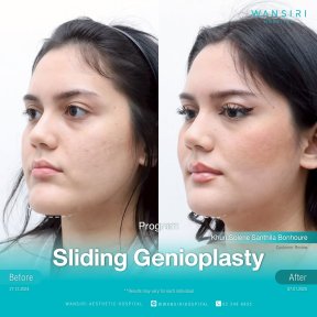 before-after photo chin-implants