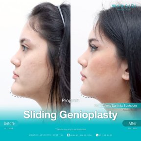 before-after photo chin-implants