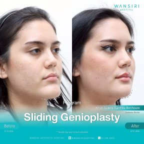 before-after photo chin-implants