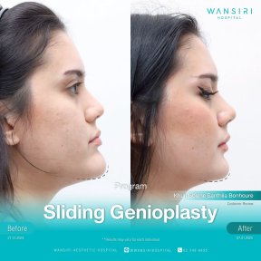 before-after photo chin-implants