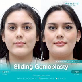 before-after photo chin-implants