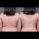 Before and after 360 liposuction results at VG Plastic Surgery, visible back contour improvement
