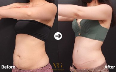 Before and after tummy tuck results at VG Plastic Surgery – visible abdominal contour improvement