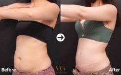 Before and after tummy tuck results at VG Plastic Surgery – visible abdominal contour improvement