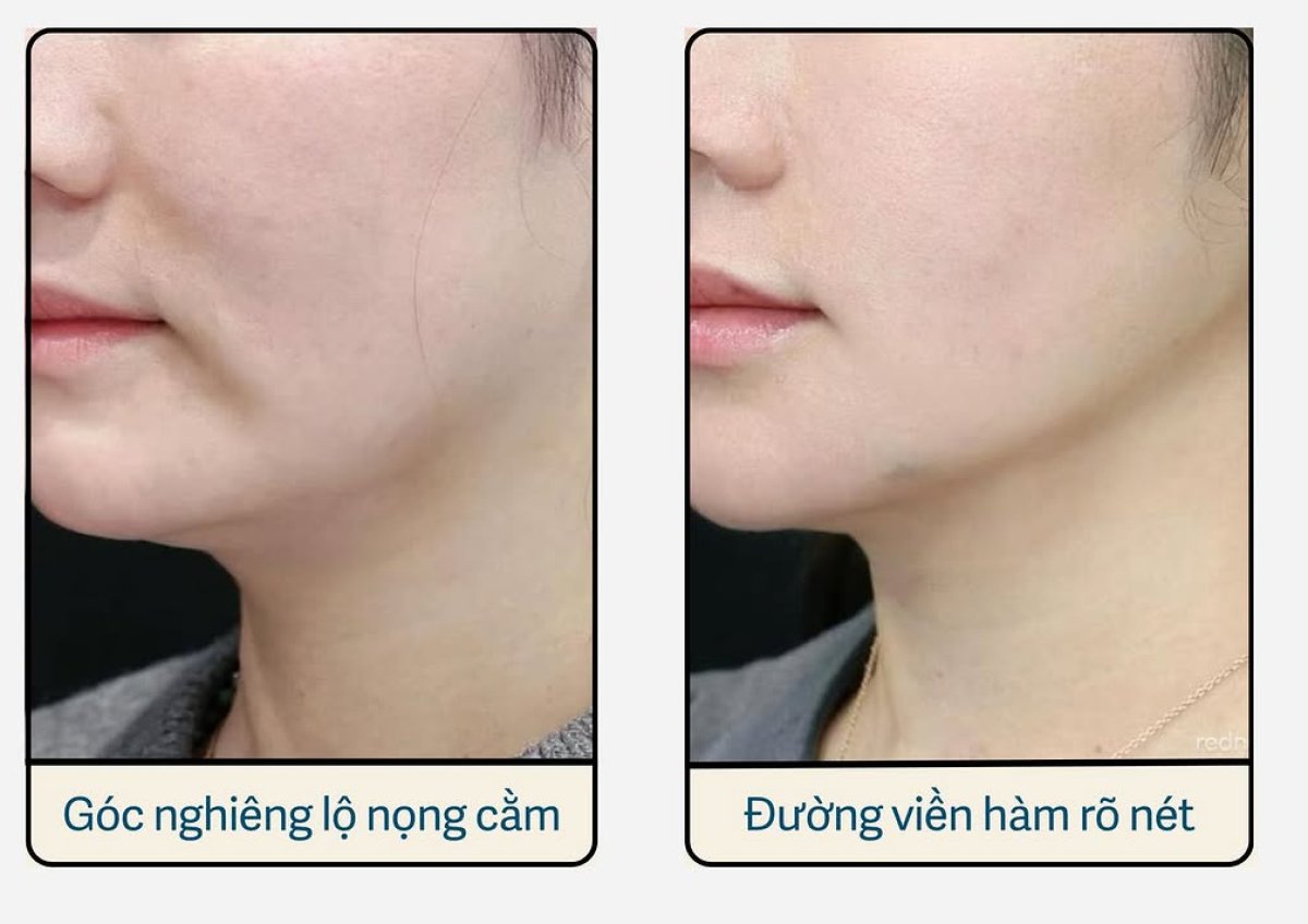 Resultados de Thermage antes y después: mejor contorno mandibular y menos papada