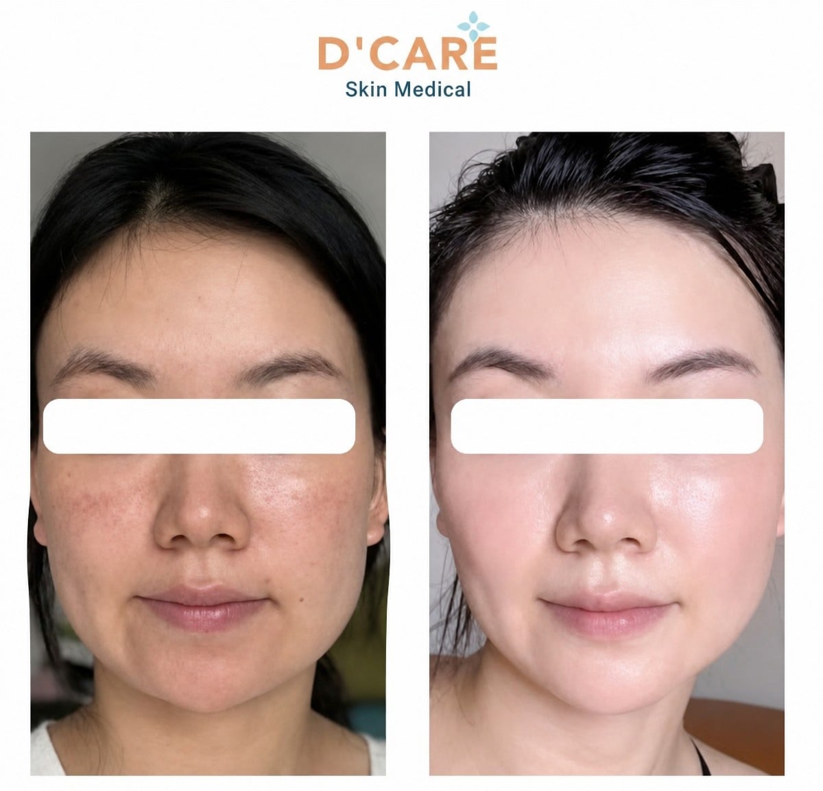 نتائج الميكرونيدلينغ قبل وبعد في D'Care Skin Medical – تحسين ملمس بشرة الوجه