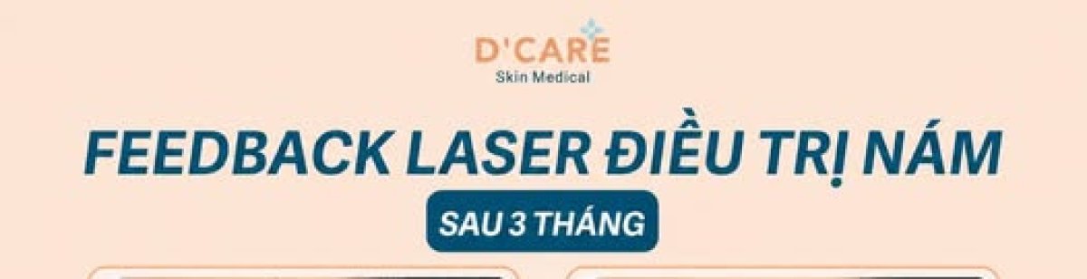 نتائج علاج الكلف بالليزر قبل وبعد في D'Care Skin Medical بعد 3 أشهر