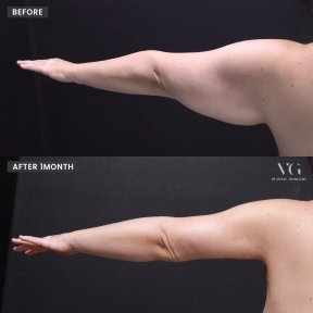 Vorher-nachher-Ergebnis BodyTite-Armkontur bei VG Plastic Surgery, sichtbare Fettreduktion