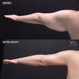 Vorher-nachher-Ergebnis BodyTite-Armkontur bei VG Plastic Surgery, sichtbare Fettreduktion