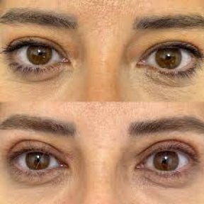 Before and after blepharoplasty results at Optimed International Hospital, eyelid correction