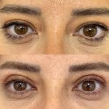 Before and after blepharoplasty results at Optimed International Hospital, eyelid correction