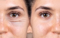 Blepharoplasty before and after results at Optimed International Hospital, eyelid correction