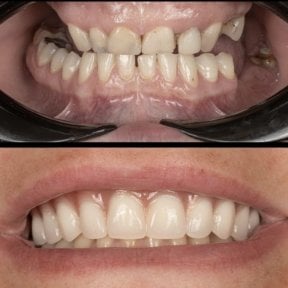 Before and after dental veneers at HALDENT Dental Clinic – smile makeover results